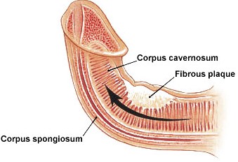 Peyronie Disease cure